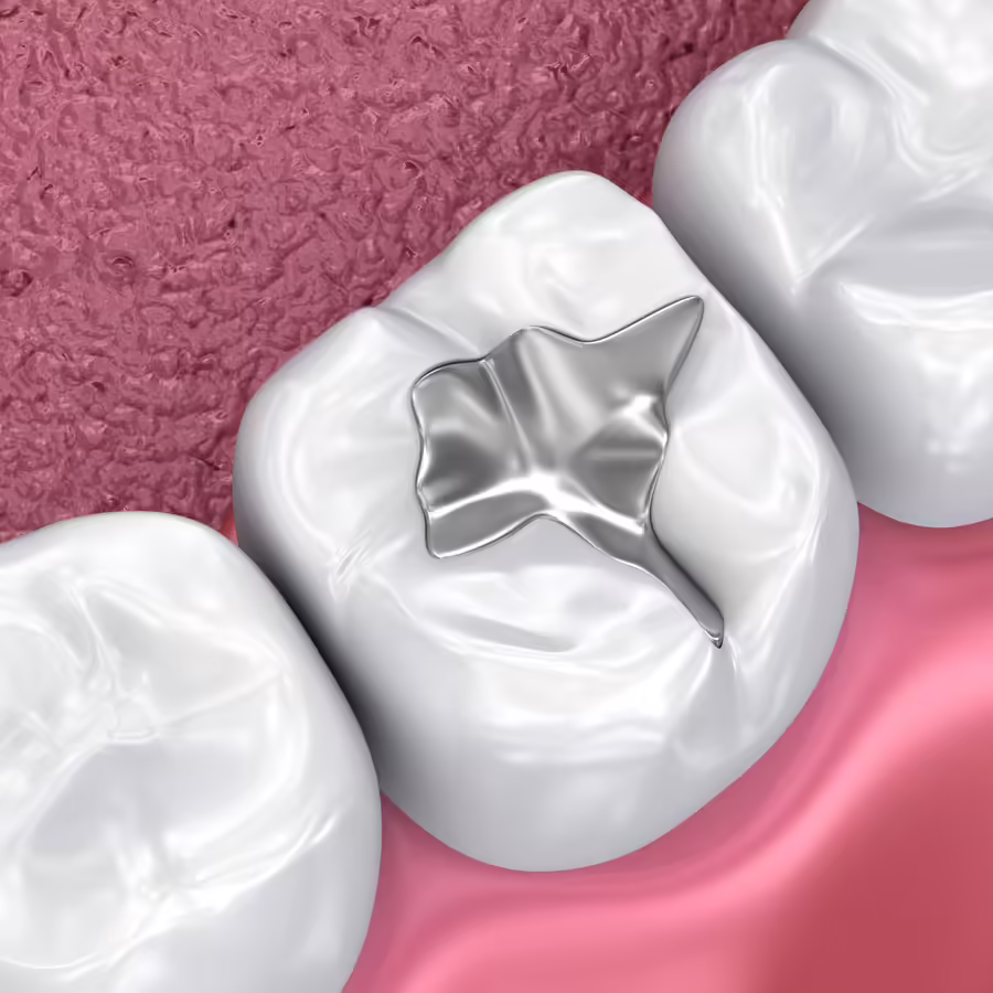 Dental Fillings