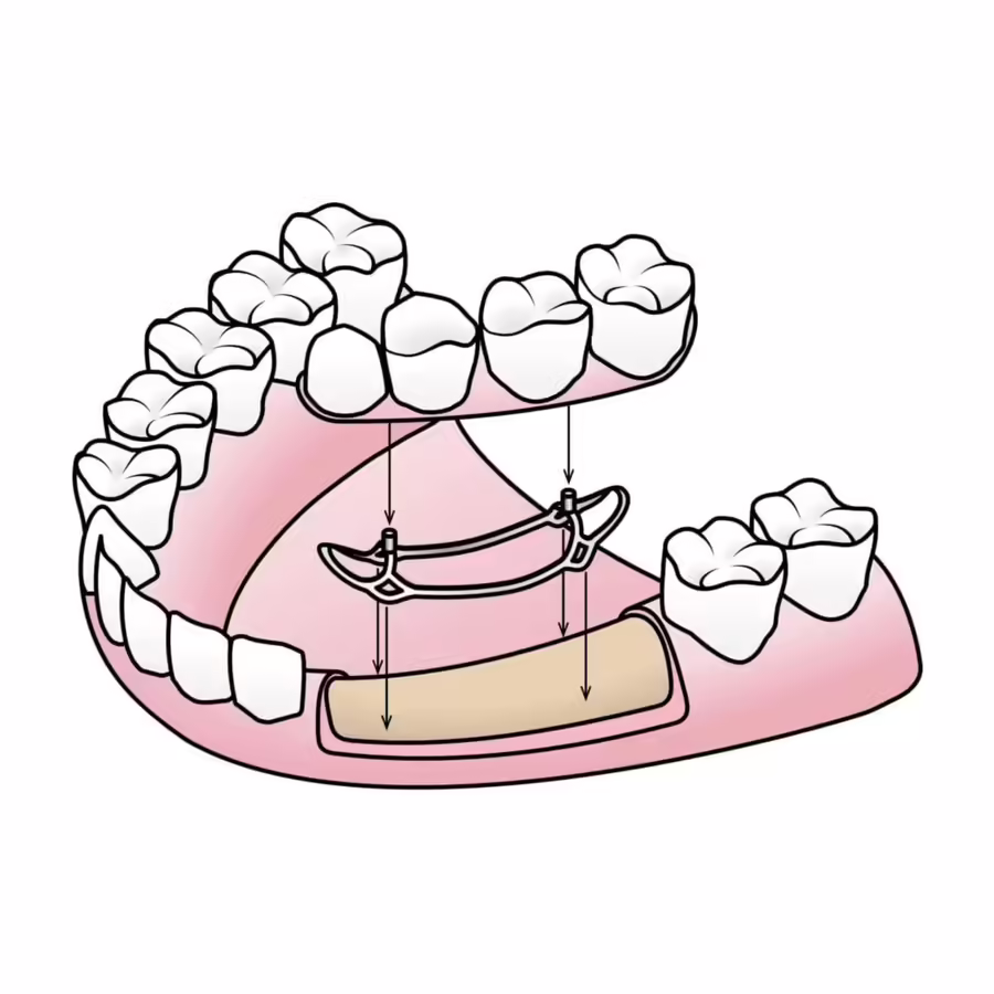 Subperiosteal implants for bone loss in Salem